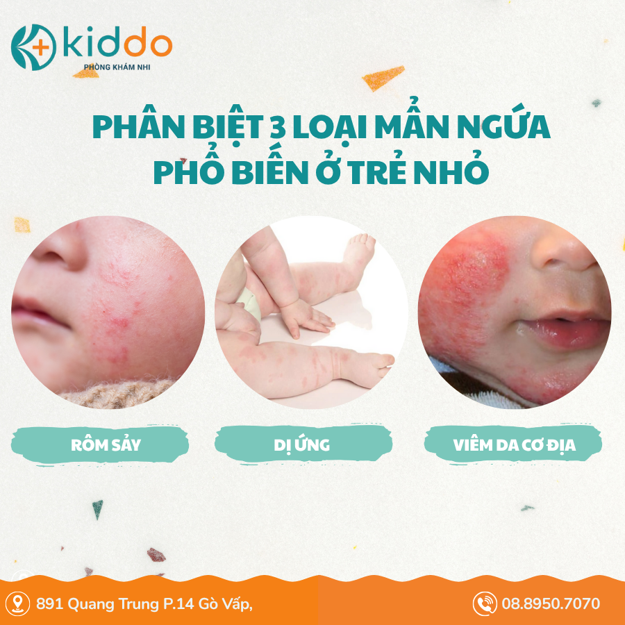 PHÂN BIỆT RÔM SẢY – DỊ ỨNG – VIÊM DA CƠ ĐỊA Ở TRẺ NHỎ - Phòng khám nhi đồng